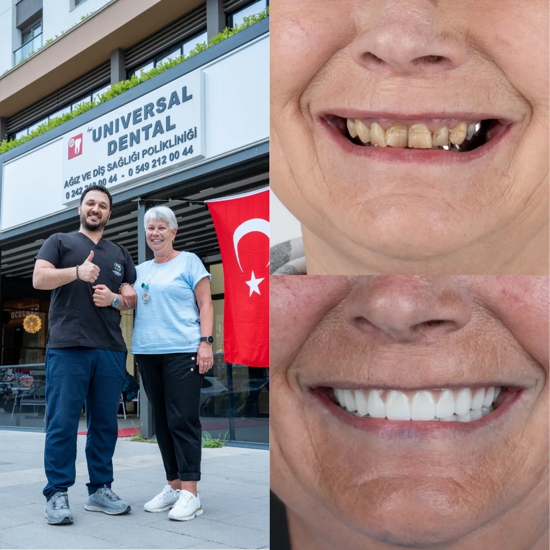 Before and after dental treatment result 1