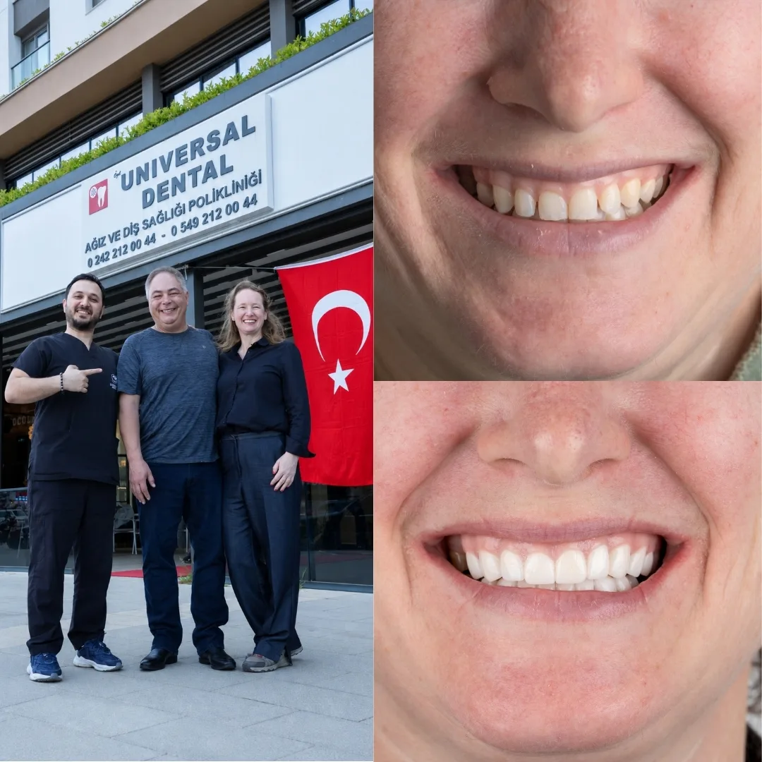 Before and after dental treatment result 2