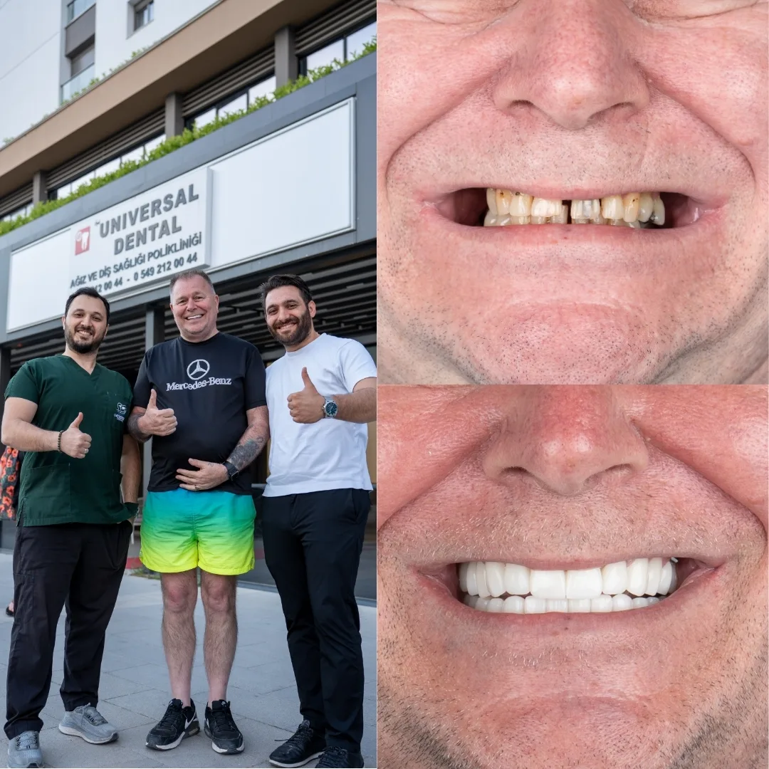 Before and after dental treatment result 3
